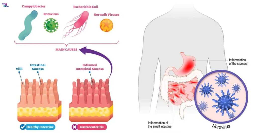 Causes Of Gastroenteritis